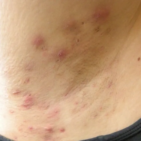 Patient consultation for hidradenitis suppurativa