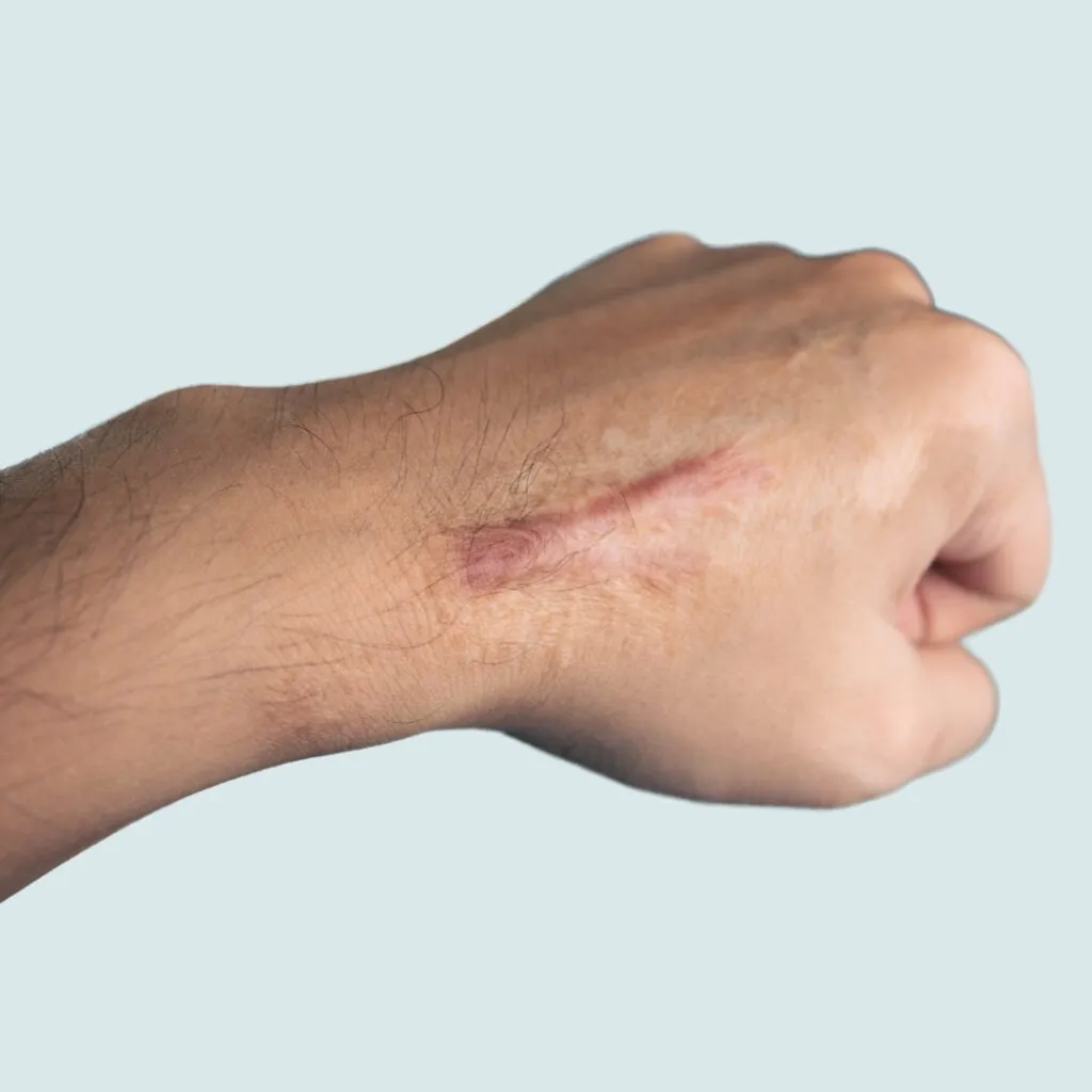 Raised keloid scar on skin