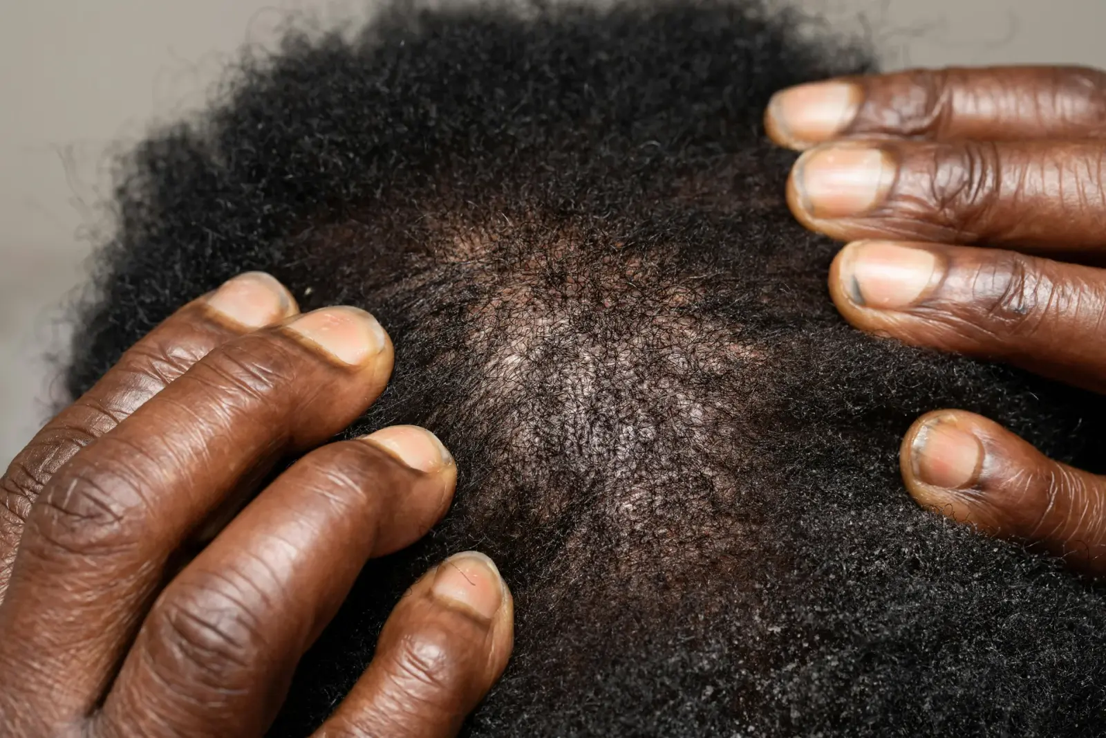 Dermatologist examining a patient’s scalp
