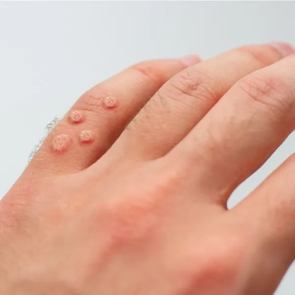 Dermatologist evaluating a mole on a patient’s back