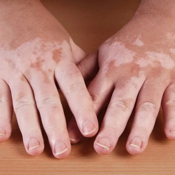 Skin showing patches of pigment loss from vitiligo