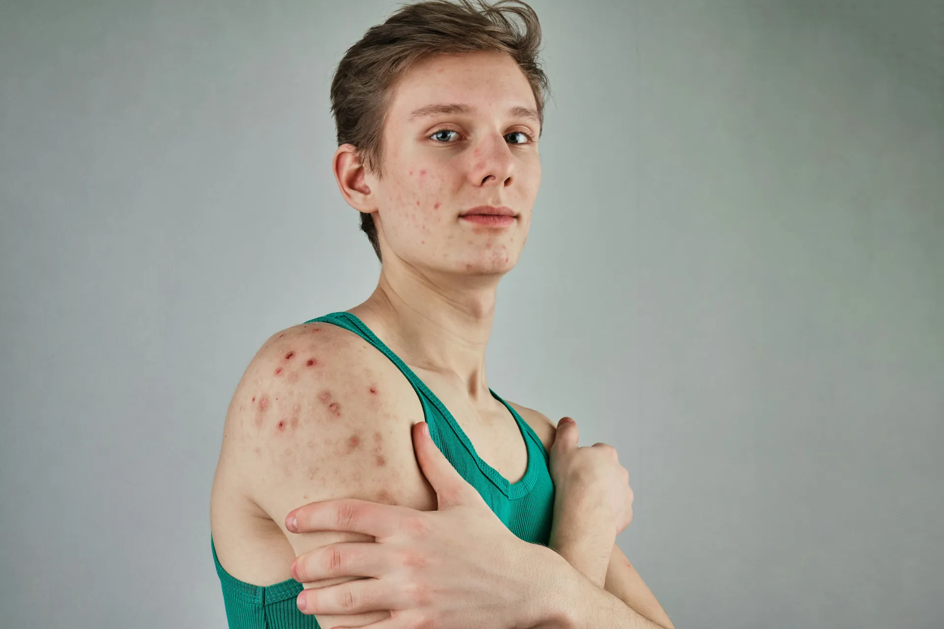 Young man with acne on his face, chest and arms