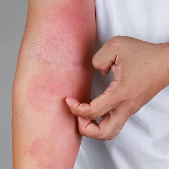 Close-up of dry, irritated eczema patches on skin