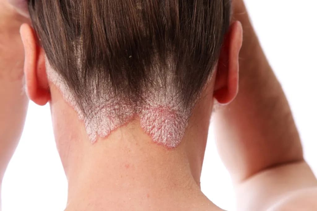 Scaly psoriasis plaques on an elbow