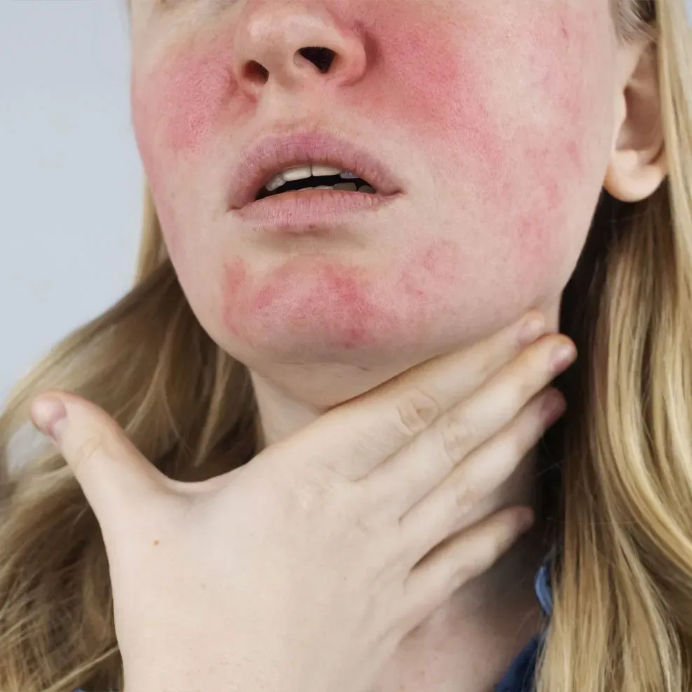 Woman with facial redness from rosacea